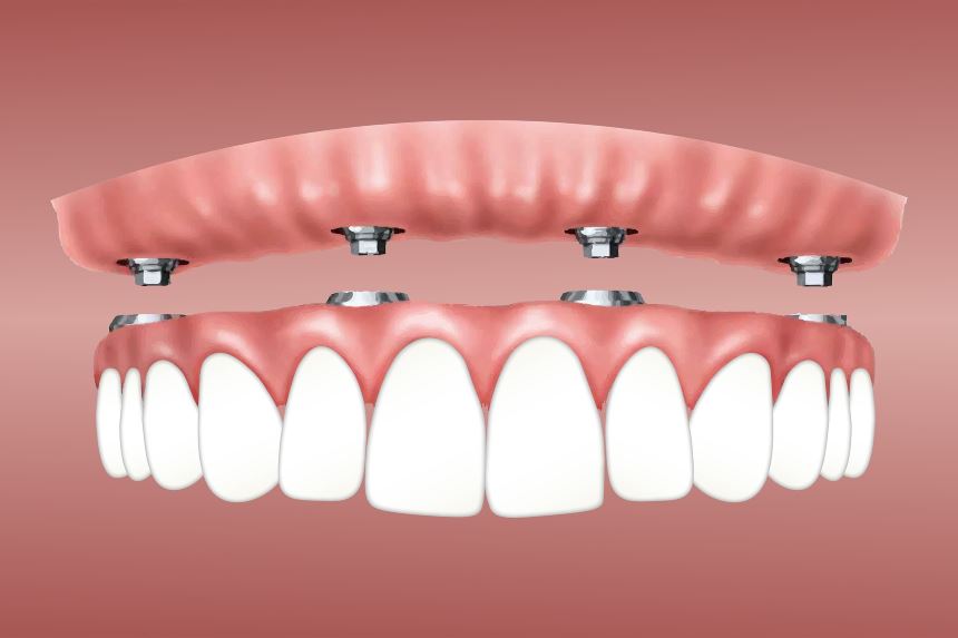 Implanty zębów – dlaczego nie są sztucznymi zębami?