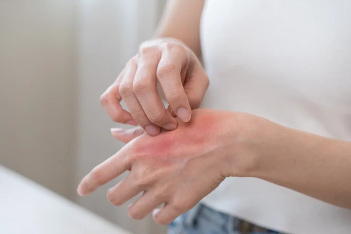 Pijawki a atopowe zapalenie skóry – czy hirudoterapia może przynieść ulgę?